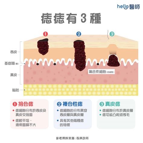 身體痣|痣是什麼？一次了解痣原因、就醫時機以及如何改善